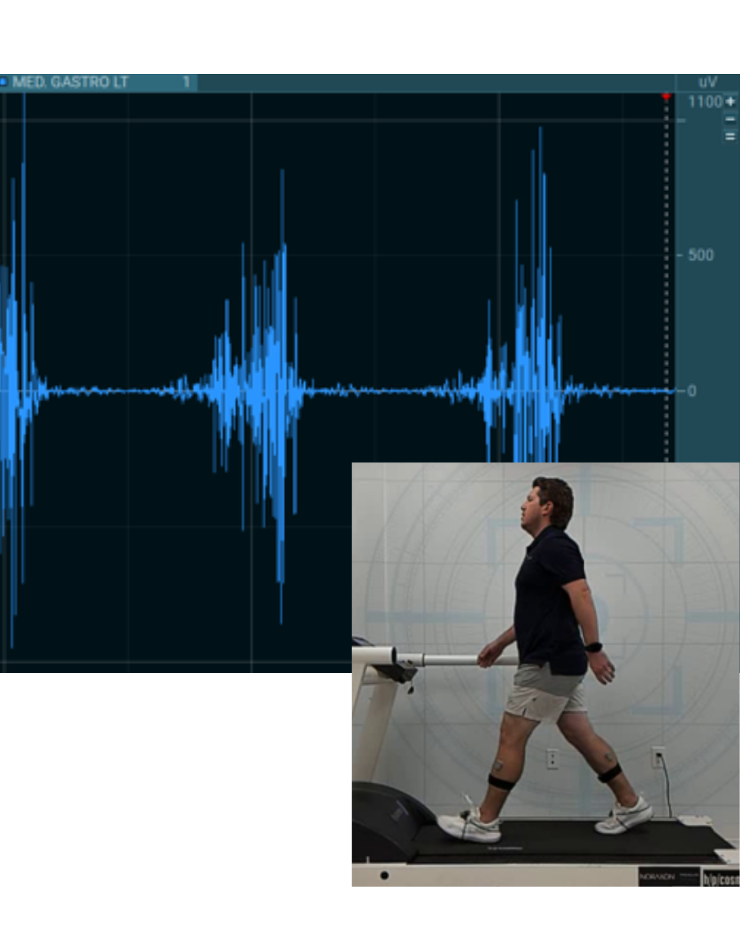 Split-screen image displaying EMG data on the left and treadmill walking on the right. The left side shows muscle activation spikes in the left medial gastrocnemius, represented by a blue waveform. The right side features a man walking on a treadmill in a lab setting, wearing EMG sensors on both calves, with a focused gait pattern captured mid-stride.